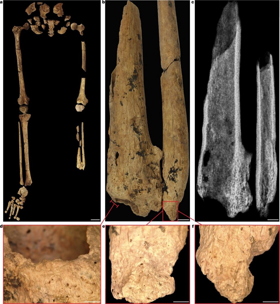 amputacja 31000 lat temu szkielet