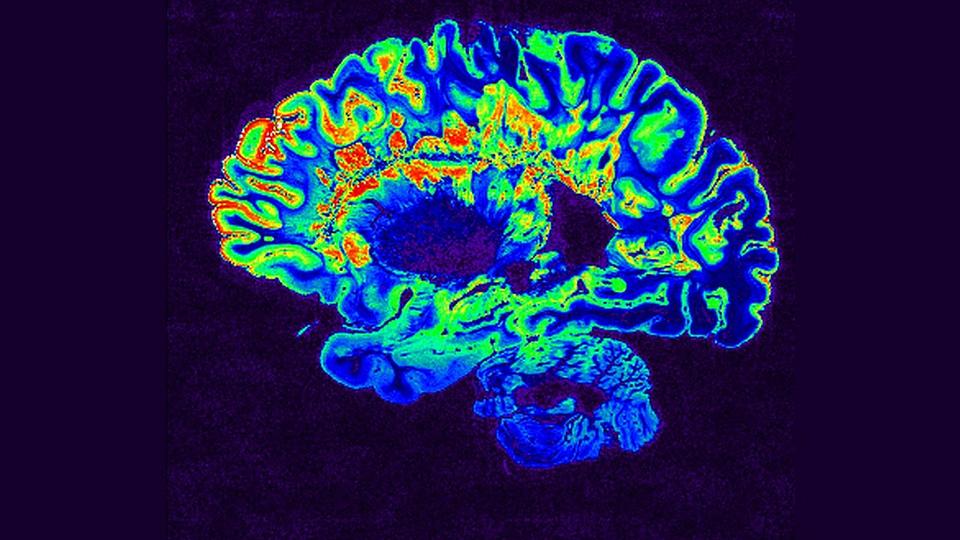Obraz MRI mózgu pacjenta ze stwardnieniem rozsianym (Źródło: hopkinsmedicine)