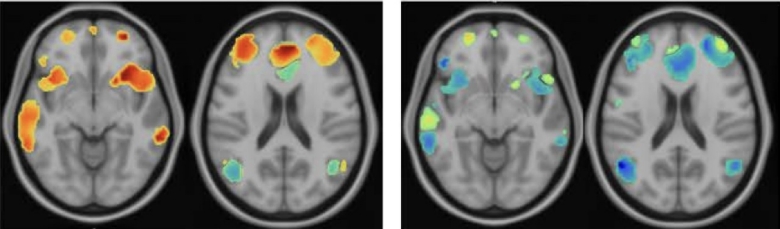 Obraz mózgu pacjenta z depresją i po leczeniu (Źródło: stanford)