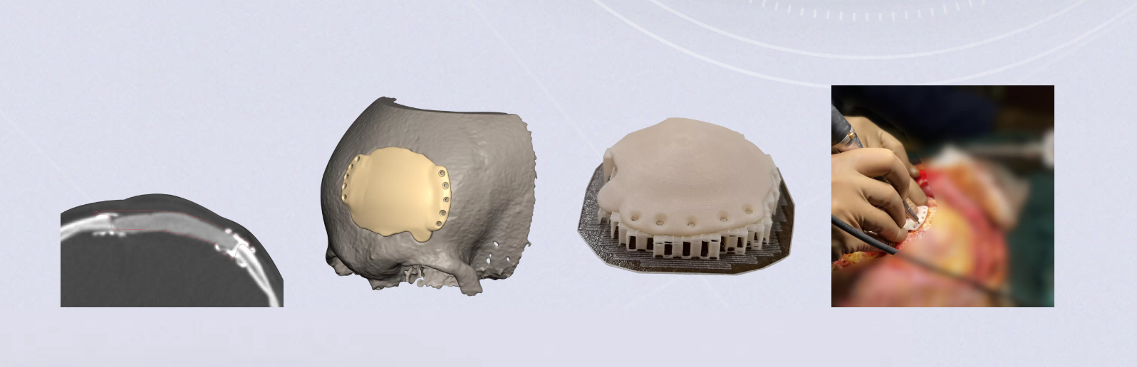 Implant czaszkowy drukowany 3D (źrodło: cyberbone.eu)